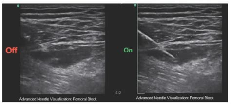 Advanced Ultrasound Guided Needle Technology Anesthesia Key