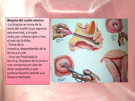 Biopsia De Cuello Uterino: Diagnóstico Rápido