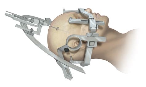 Diagnostic Accuracy Of Stereotactic Brain Biopsy For Intracranial