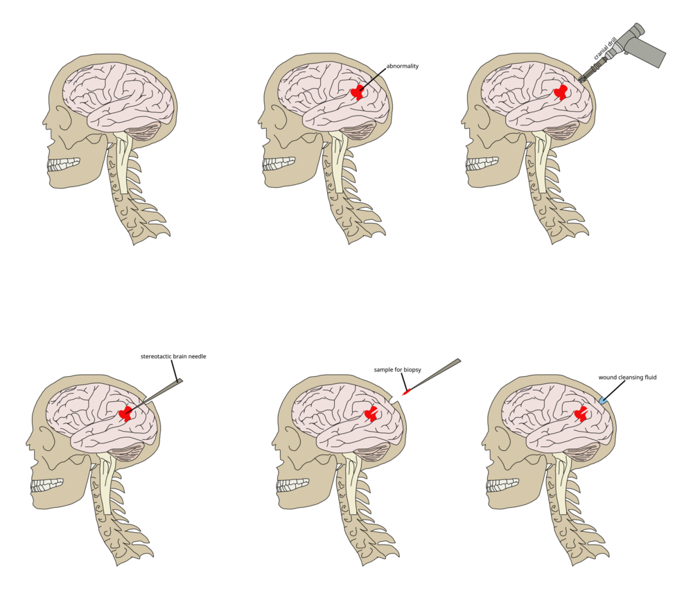 Stereotactic Brain Biopsy: A Comprehensive Guide To Precision Diagnosis