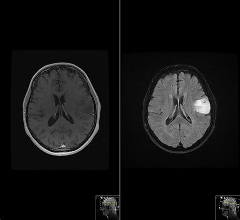 Stereotactic Brain Biopsy In Eloquent Areas Assisted By Navi