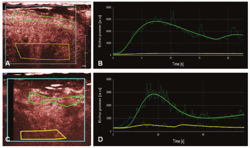 Ultrasound Perfusion Imaging Techniques And Analytical Methods